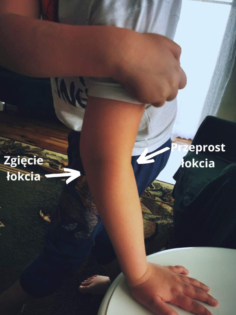 Przeprosty stawów łokciowych; hipermobilnośc stawowa u dziecka