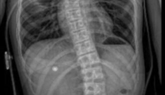 Skolioza dlaczego powstaje? Skolioza jak leczyć? Skolioza czy boli? Objawy skoliozy