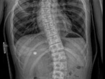 Gołębi chód u dziecka – przyczyny, objawy i ćwiczenia korekcyjne