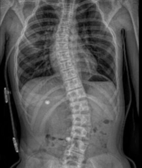 Skolioza dlaczego powstaje? Skolioza jak leczyć? Skolioza czy boli? Objawy skoliozy
